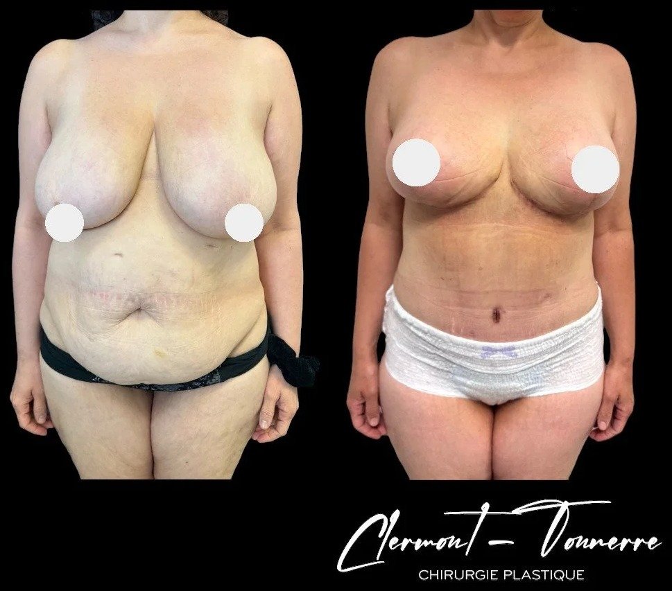 Résultat abdominoplastie — lifting abdominal Dr. de Clermont-Tonnerre