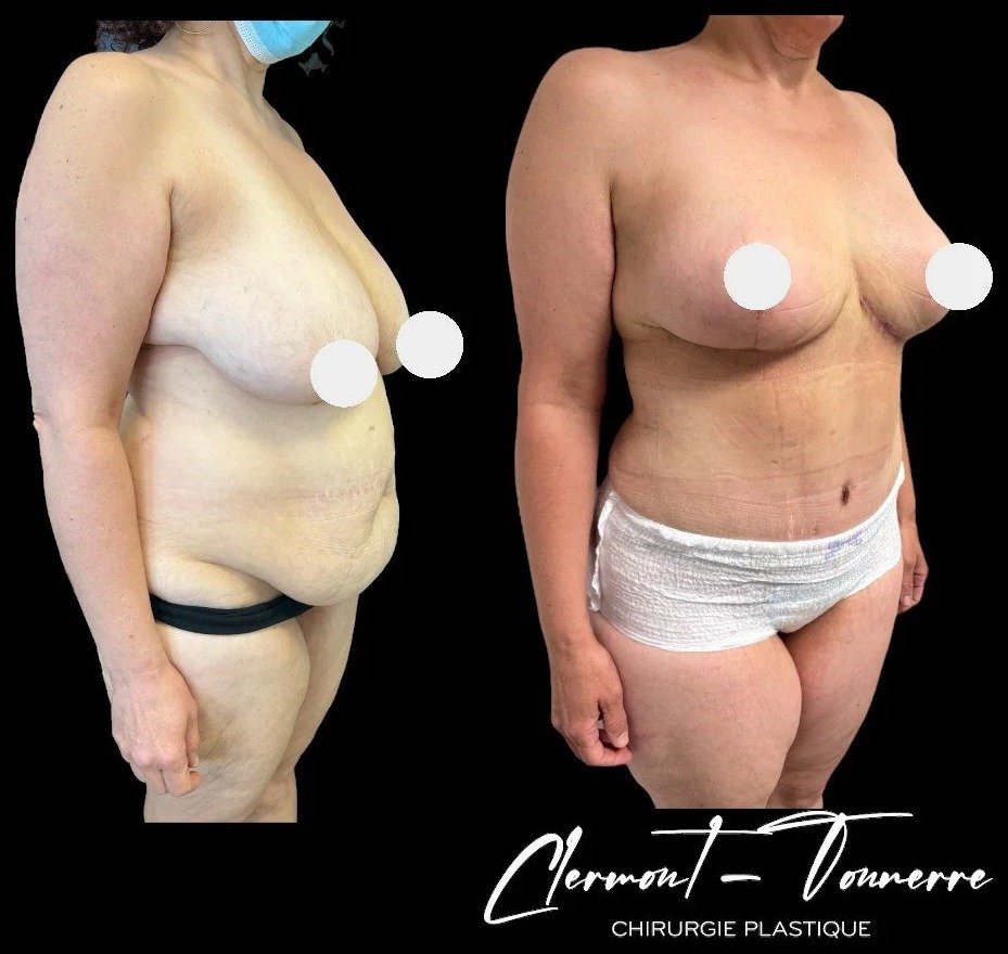 Avant/après abdominoplastie — ventre plat Paris & Pontoise