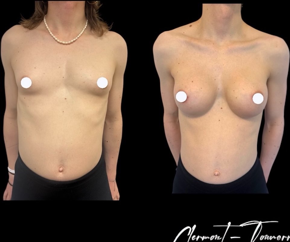 Avant après féminisation thoracique — vue de face — Dr. de Clermont-Tonnerre