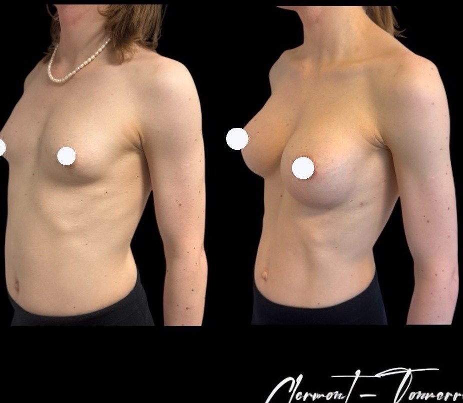 Avant après féminisation thoracique — vue 3/4 — Dr. de Clermont-Tonnerre