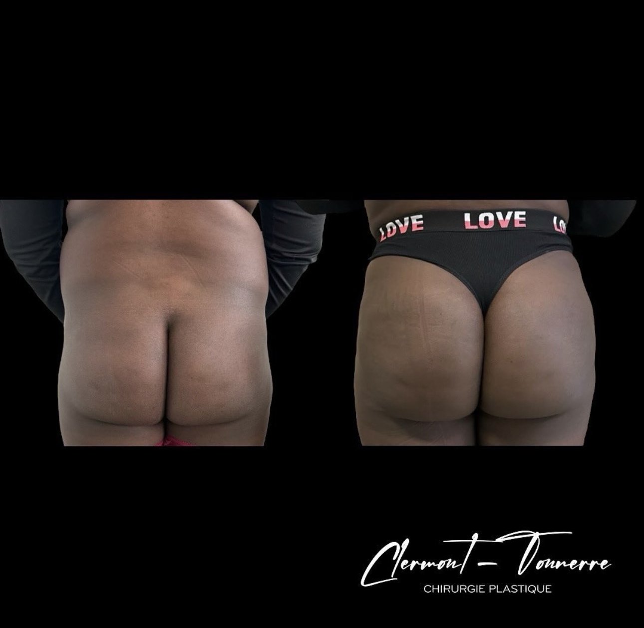 Avant après Brazilian Butt Lift (BBL) — Dr. de Clermont-Tonnerre Paris