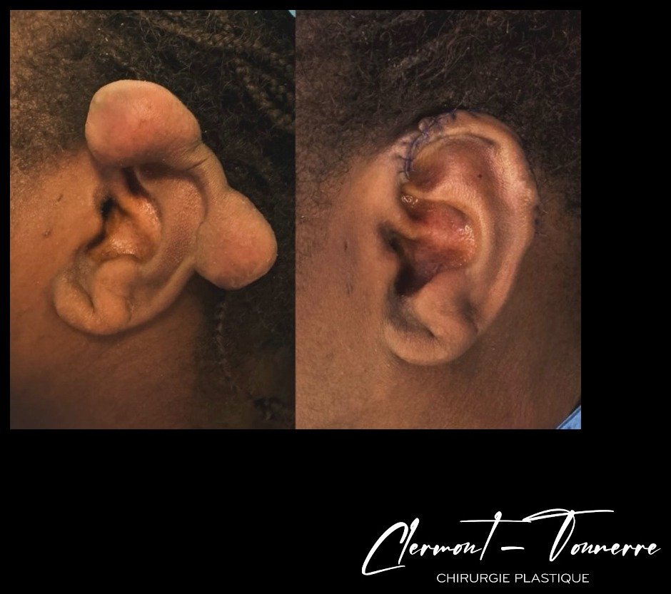 Avant après chéloïde de l'oreille — exérèse chirurgicale — Dr. de Clermont-Tonnerre