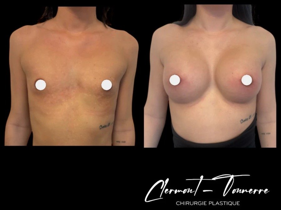 Avant après féminisation thoracique — vue de face — Dr. de Clermont-Tonnerre