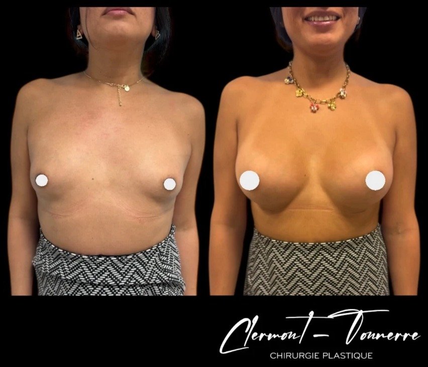 Avant après féminisation thoracique — vue de face — Dr. de Clermont-Tonnerre
