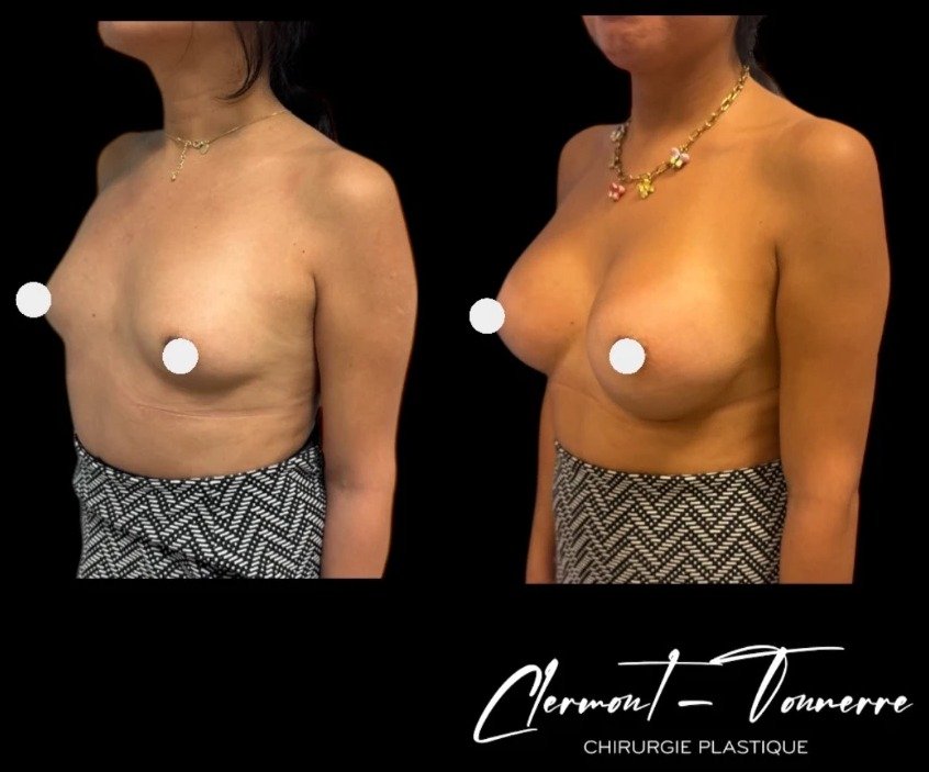 Avant après féminisation thoracique — vue 3/4 — Dr. de Clermont-Tonnerre