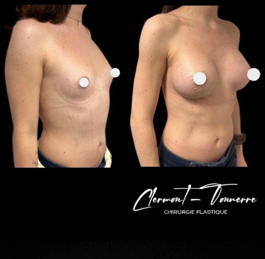 Avant après féminisation thoracique — vue 3/4 — Dr. de Clermont-Tonnerre