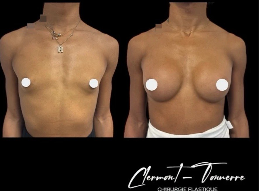 Avant après féminisation thoracique — vue de face — Dr. de Clermont-Tonnerre