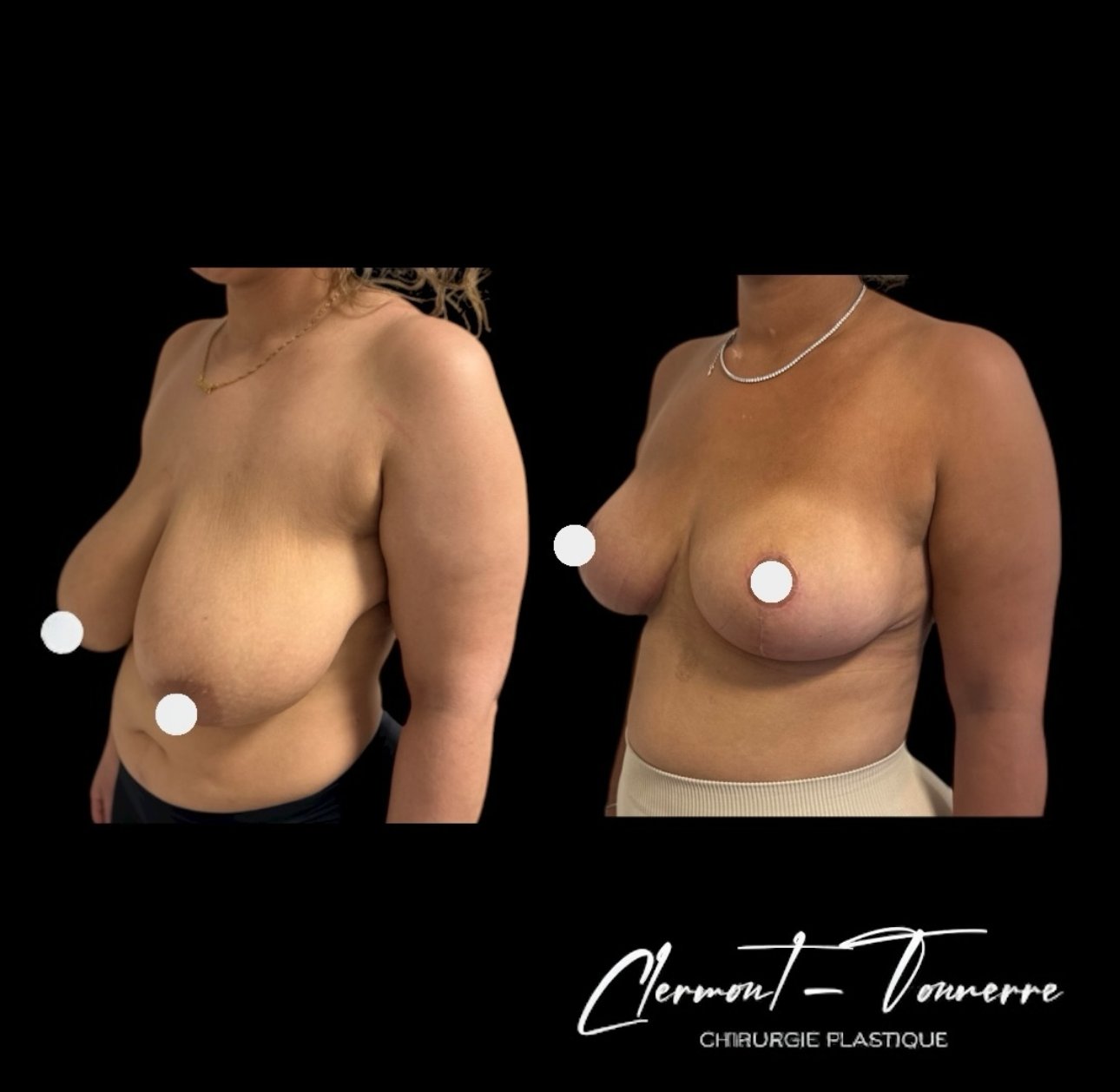 Avant après lifting mammaire (mastopexie) — vue de face — Dr. de Clermont-Tonnerre Paris