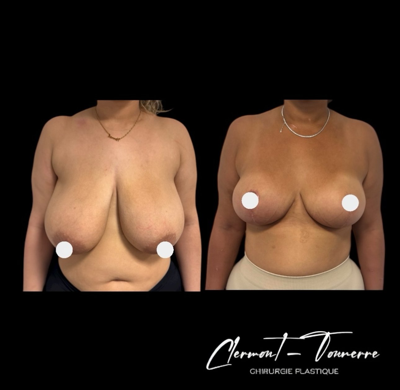 Avant après lifting mammaire — vue 3/4 — Dr. de Clermont-Tonnerre Paris