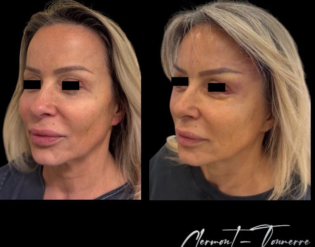 Avant après lifting du sourcil (brow lift) — Dr. de Clermont-Tonnerre Paris