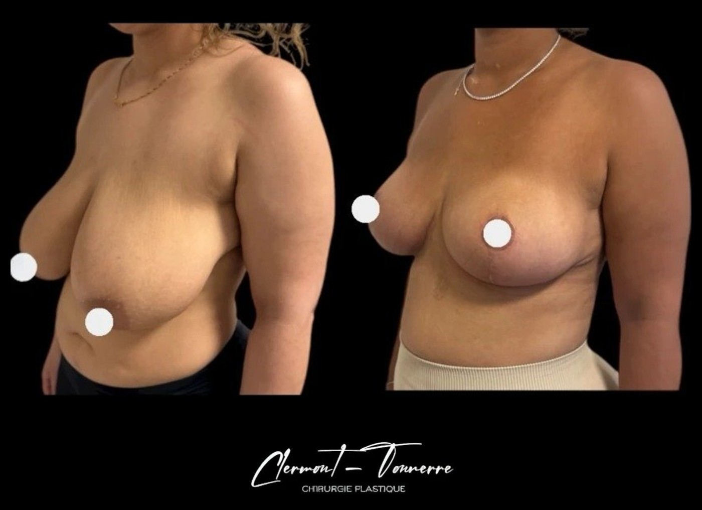 Avant après réduction mammaire — vue 3/4 — Dr. de Clermont-Tonnerre