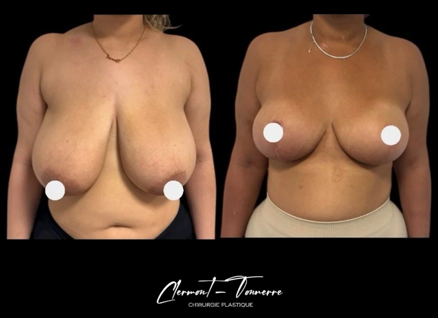 Avant après réduction mammaire — vue de face — Dr. de Clermont-Tonnerre