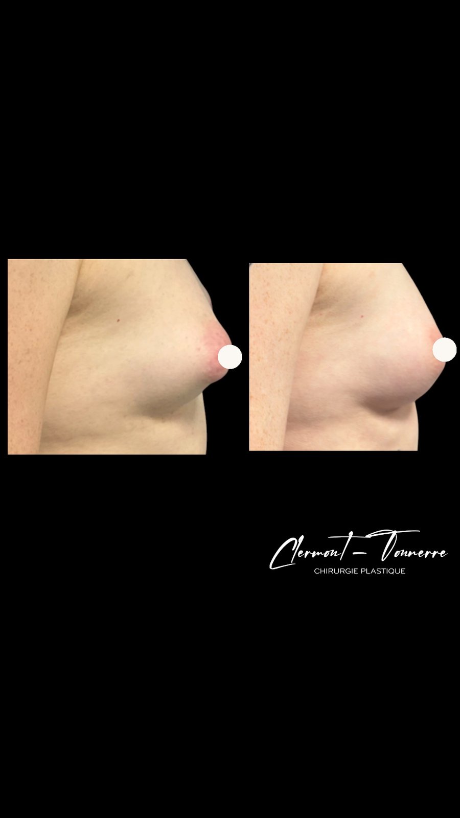 Avant après lipofilling mammaire — profil — Dr. de Clermont-Tonnerre