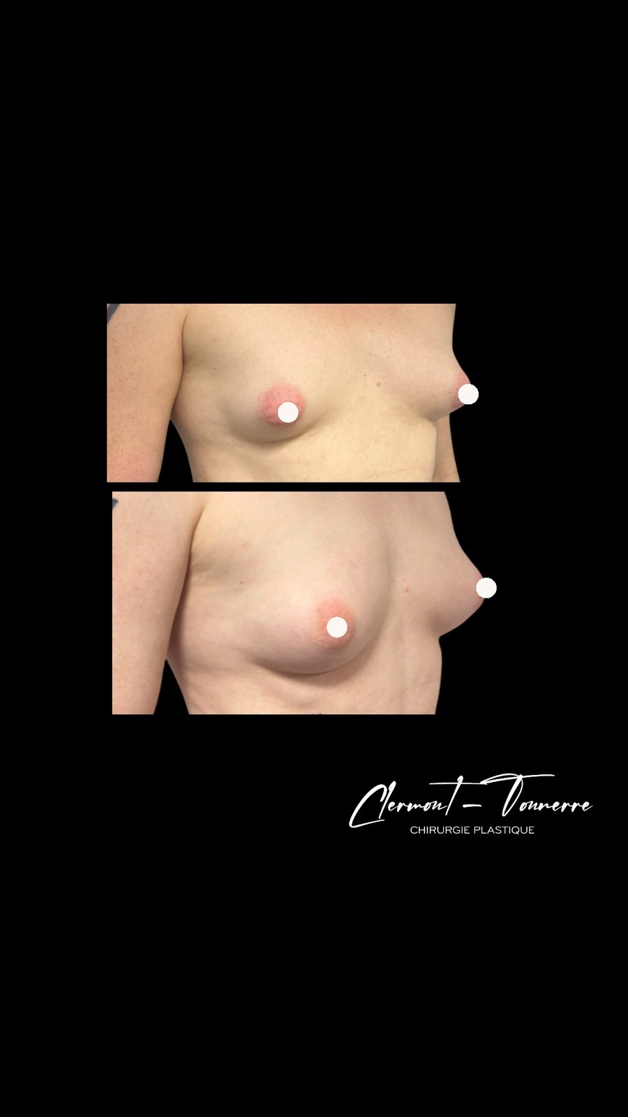 Avant après lipofilling mammaire — vue 3/4 — Dr. de Clermont-Tonnerre