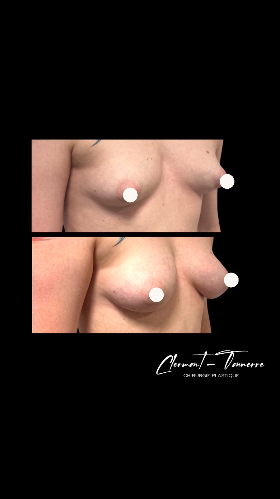 Avant après lipofilling mammaire — vue 3/4 — Dr. de Clermont-Tonnerre