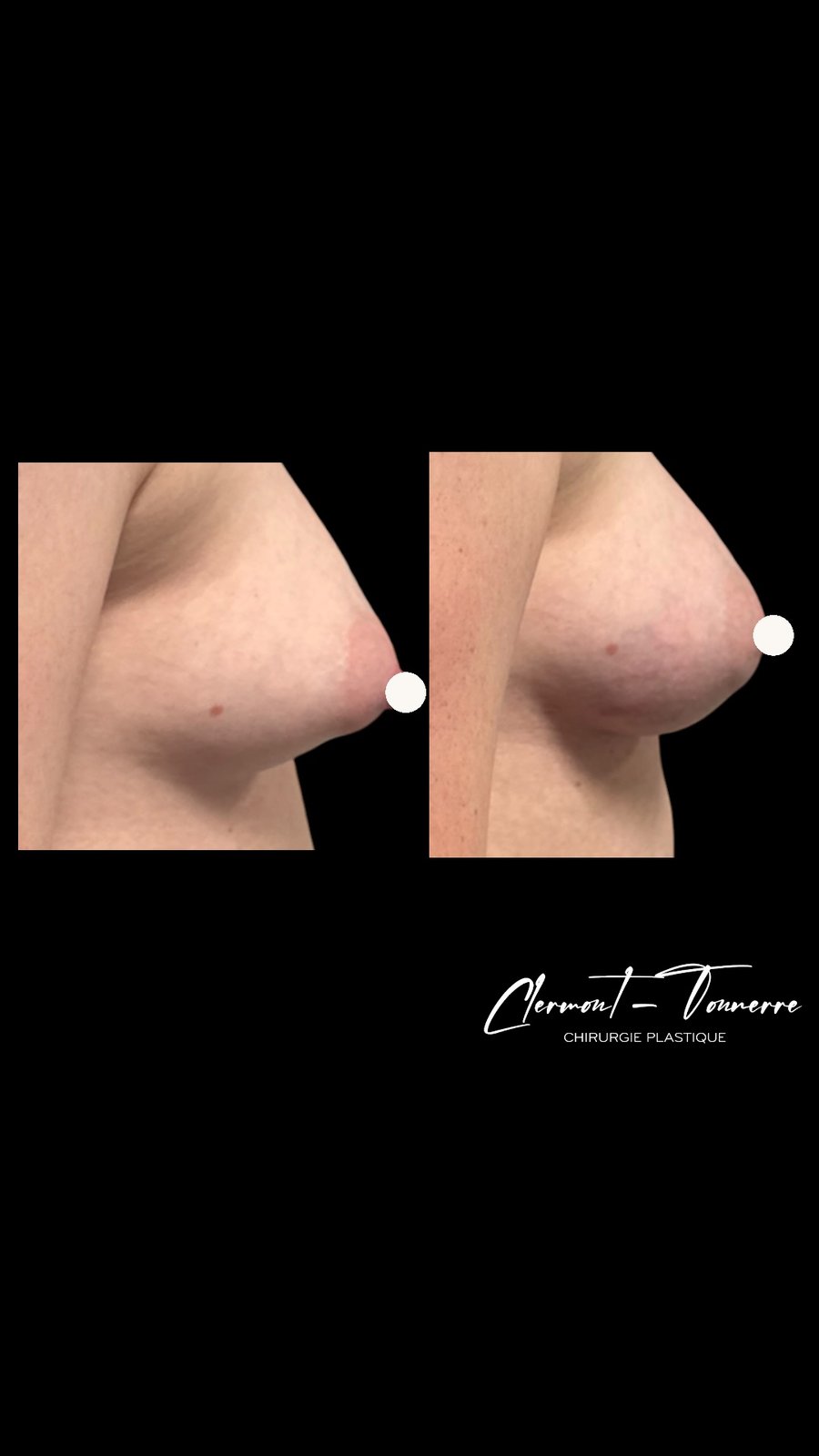 Avant après lipofilling mammaire — profil — Dr. de Clermont-Tonnerre