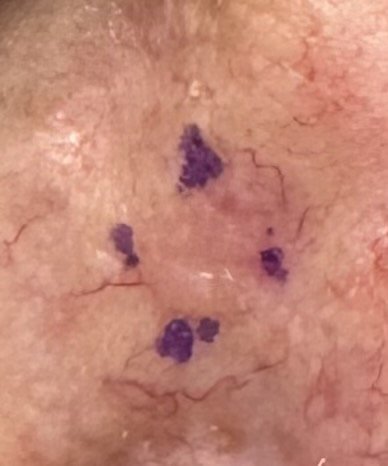 Exérèse de carcinome cutané — cas clinique 4