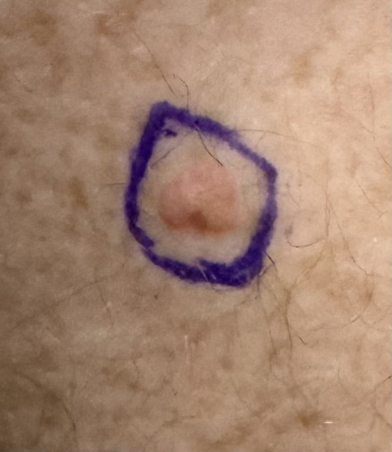 Exérèse de carcinome cutané — cas clinique 1
