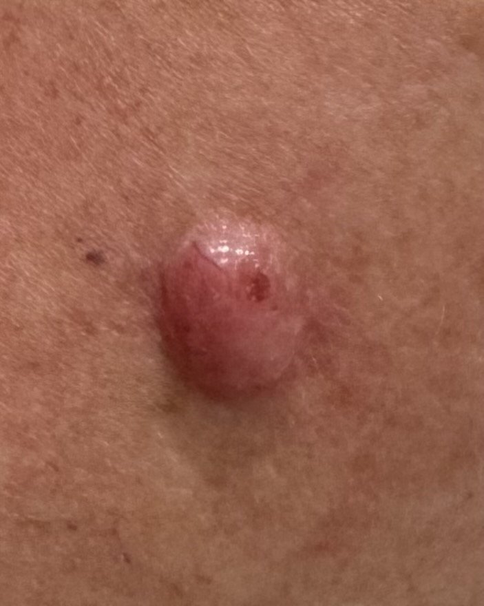 Exérèse de carcinome cutané — cas clinique 3