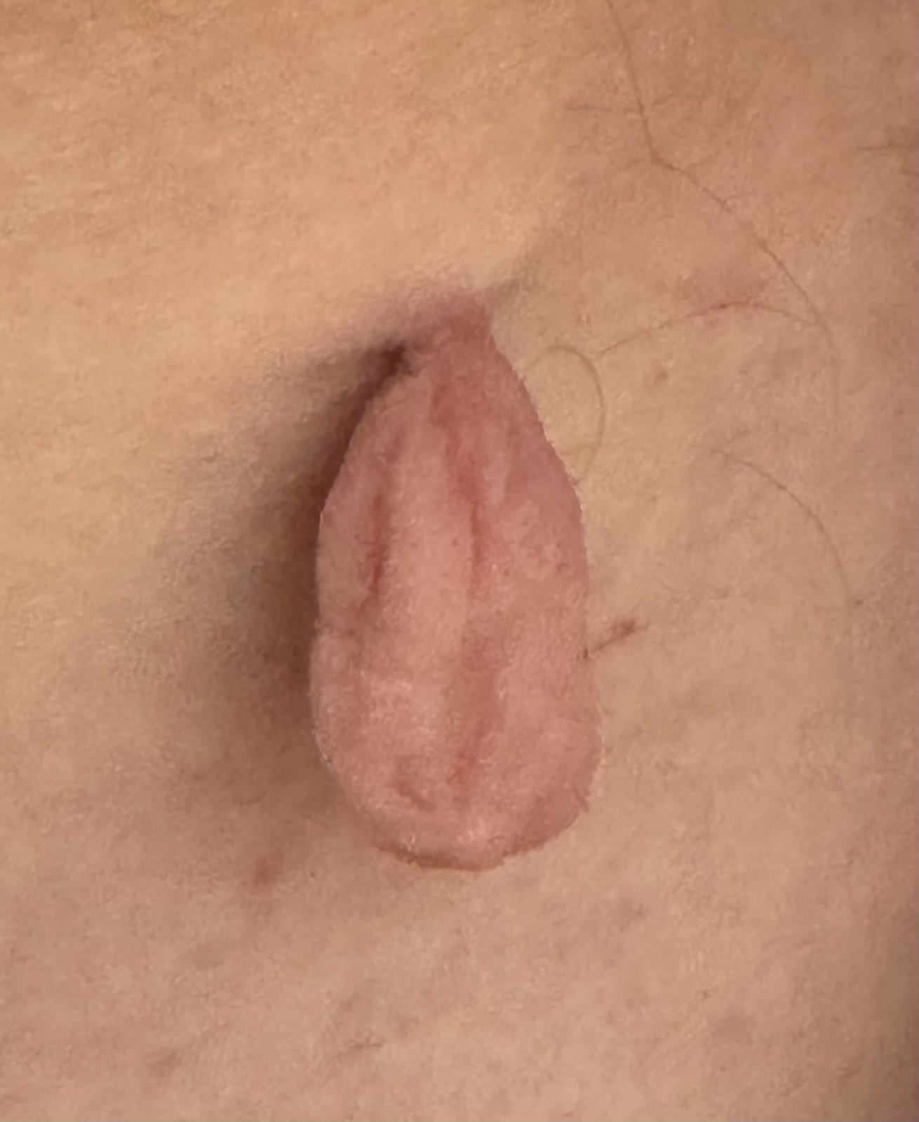 Molluscum contagiosum — exemple clinique