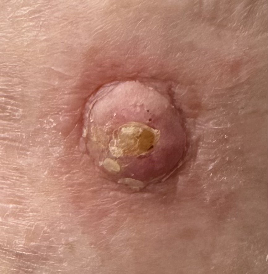 Exérèse de carcinome cutané — cas clinique 5