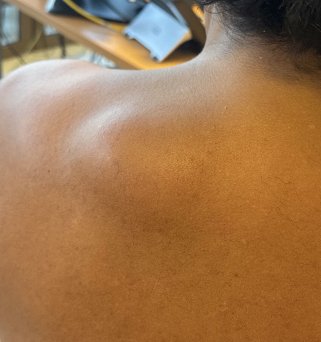Lipome épaule — exemple clinique