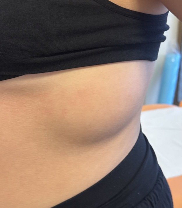 Lipome flanc — exemple clinique