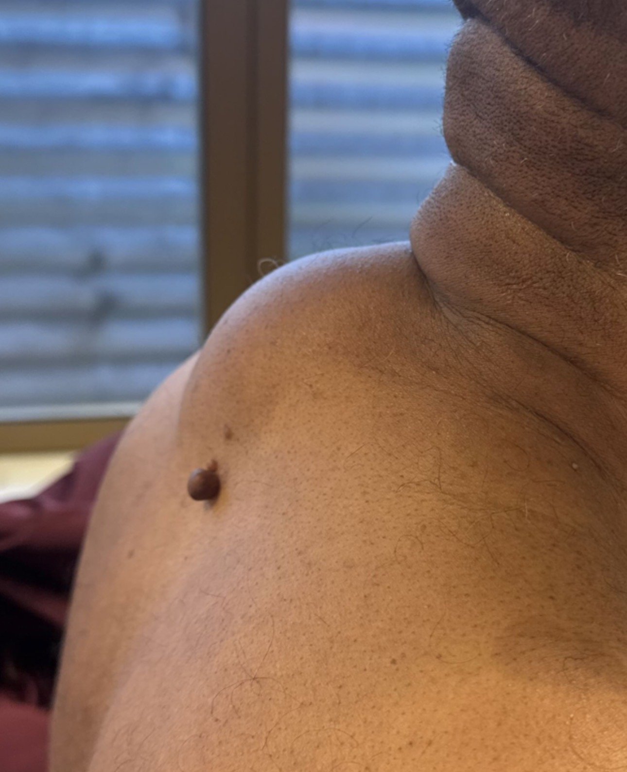 Lipome dos — exemple clinique