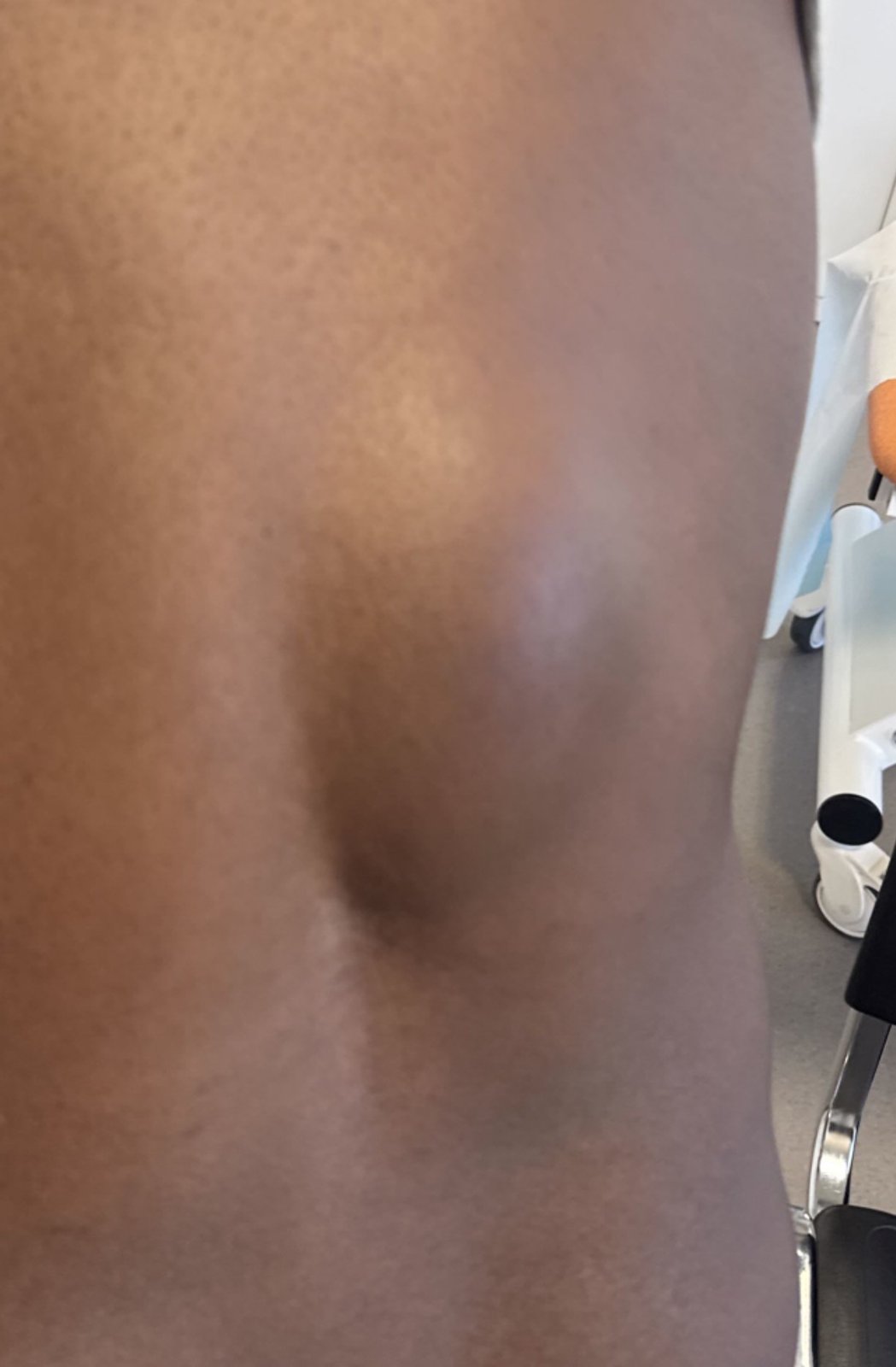 Lipome — exemple clinique