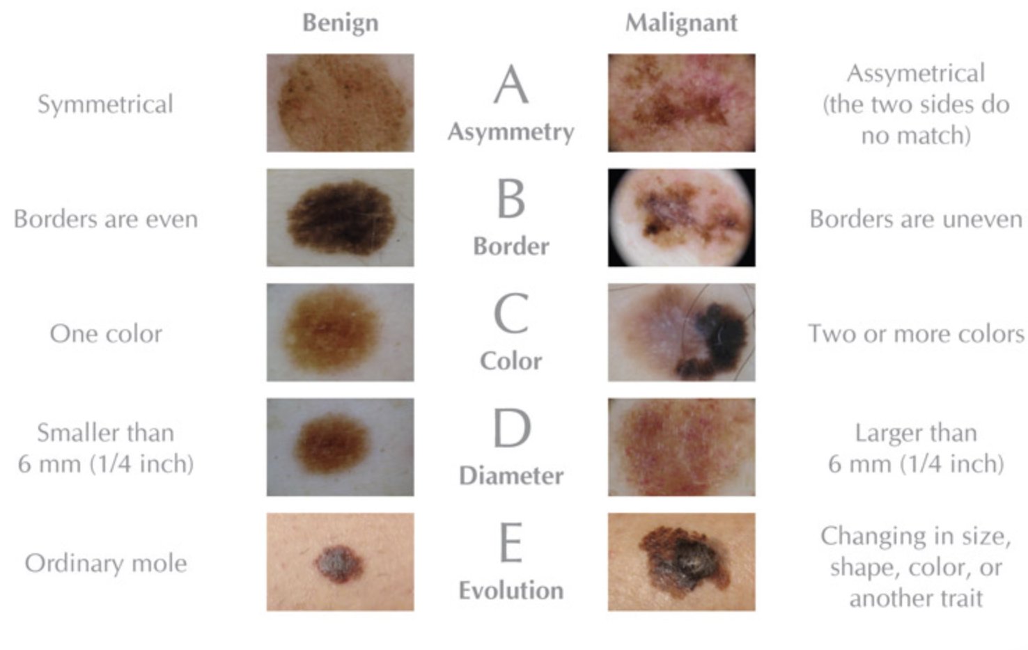 Règle ABCDE mélanome — comparaison nævus bénin et malin