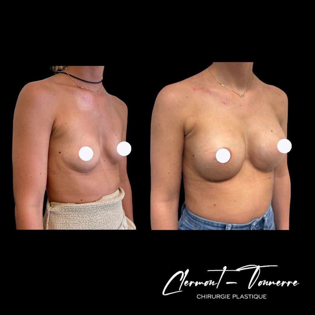 Résultat augmentation mammaire naturelle — Pontoise & Paris 16e