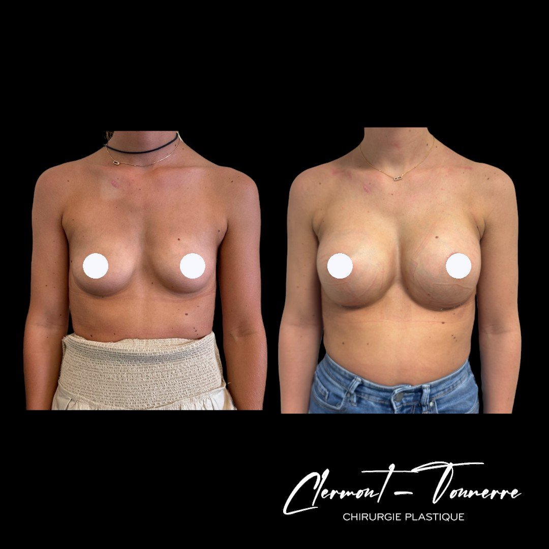 Résultat prothèses mammaires — chirurgie des seins Pontoise