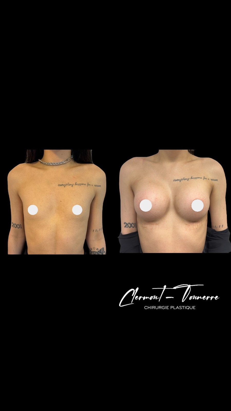 Résultat augmentation mammaire féminisation thoracique MtF