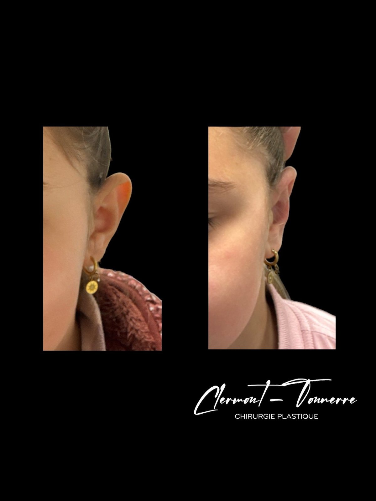 Otoplastie avant après — angle auriculaire harmonieux