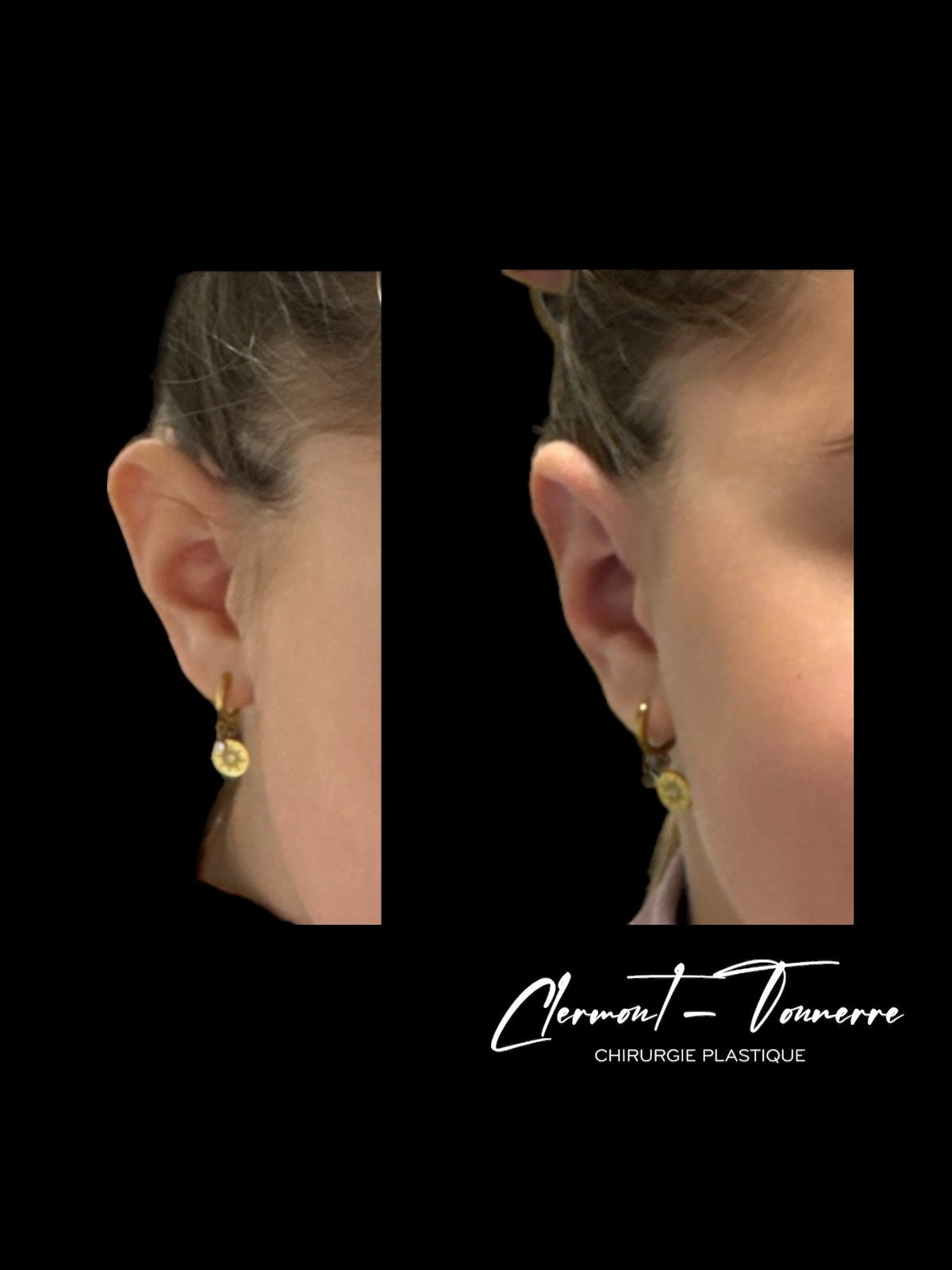 Otoplastie résultat — oreilles repositionnées