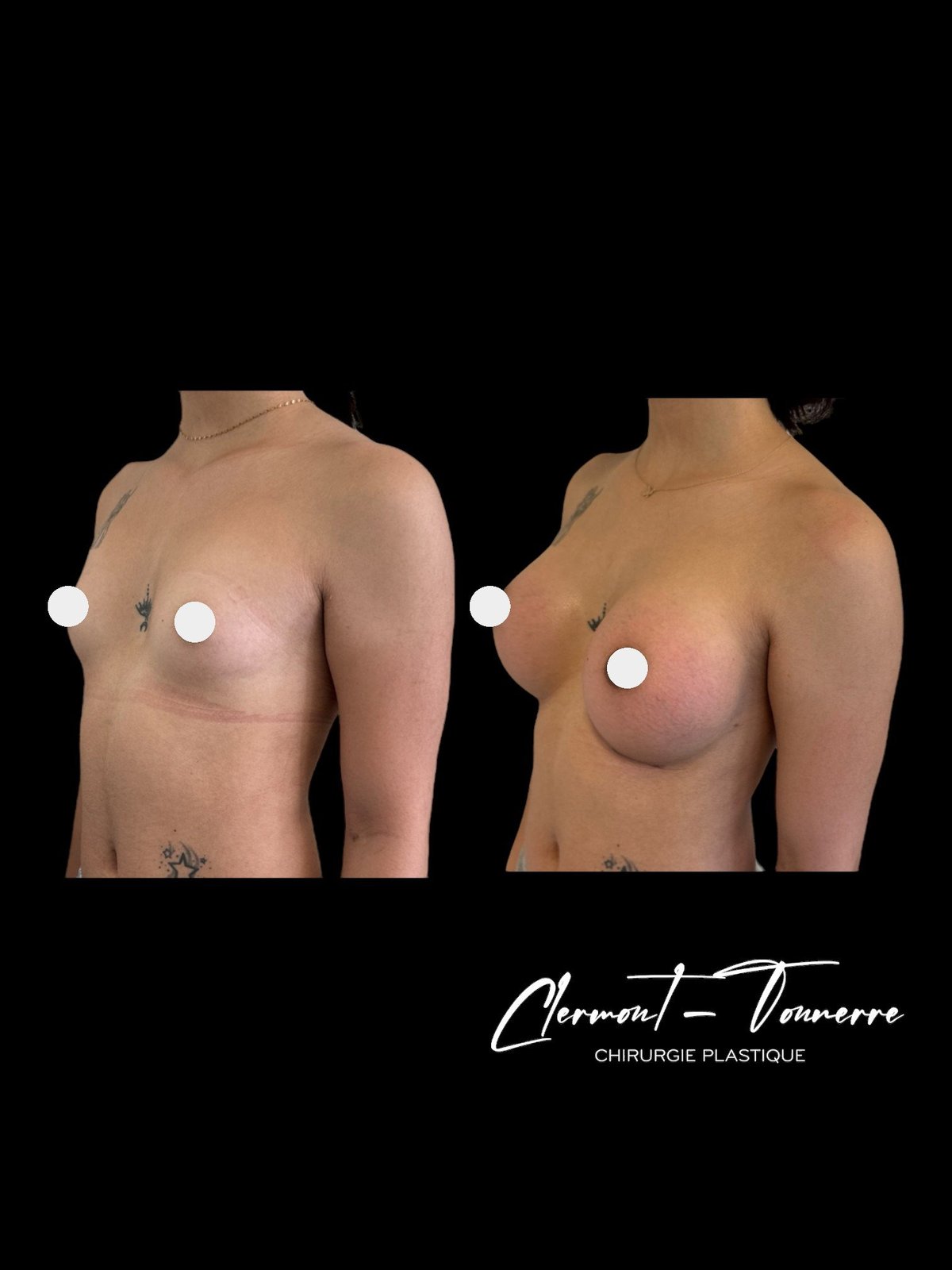 Résultat féminisation des seins — chirurgie esthétique trans Paris 16e