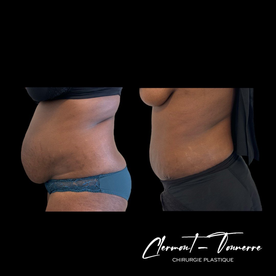 Avant/après abdominoplastie — résultat naturel et durable