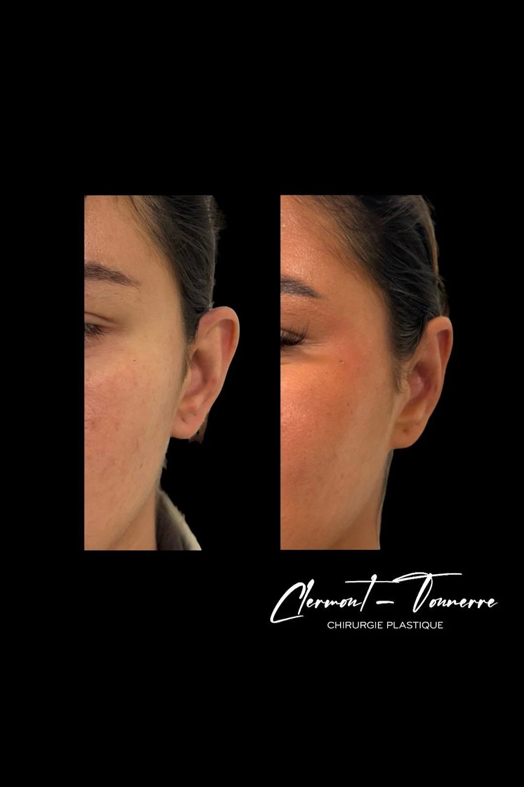 Otoplastie résultat — correction oreilles décollées
