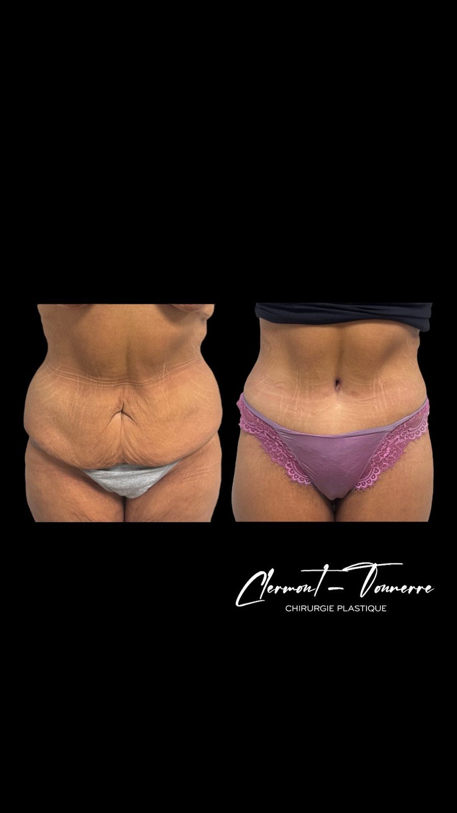 Résultat lifting abdominal — cicatrice discrète abdominoplastie