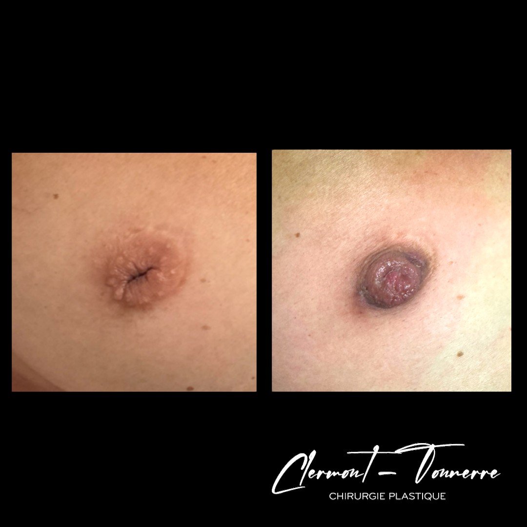Résultat correction mamelon invaginé — Dr. de Clermont-Tonnerre Paris