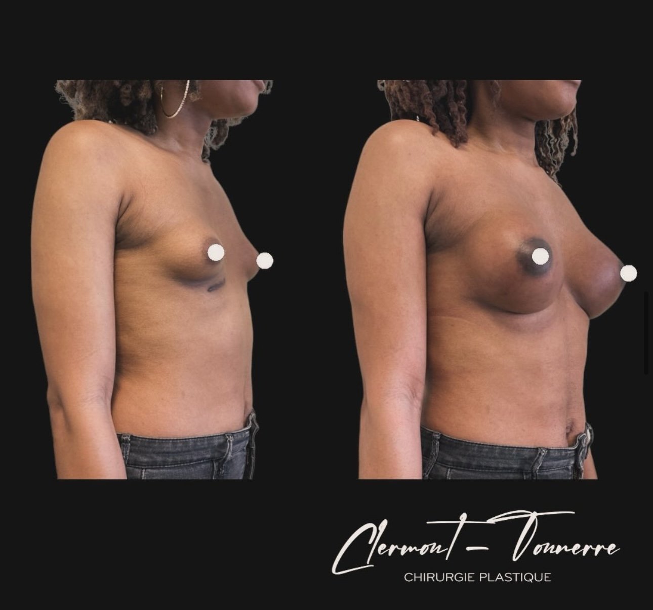 Résultat augmentation mammaire — Dr. de Clermont-Tonnerre