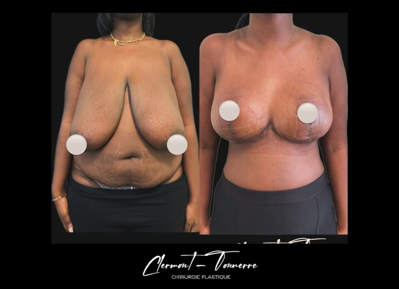 Avant après réduction mammaire — chirurgie des seins Paris 16e