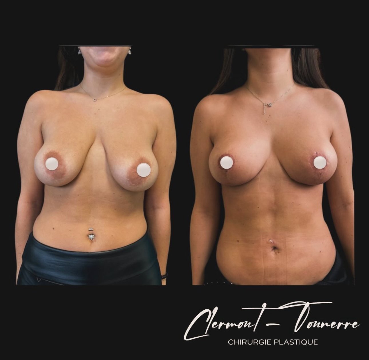 Résultat lifting mammaire (mastopexie) — Dr. de Clermont-Tonnerre