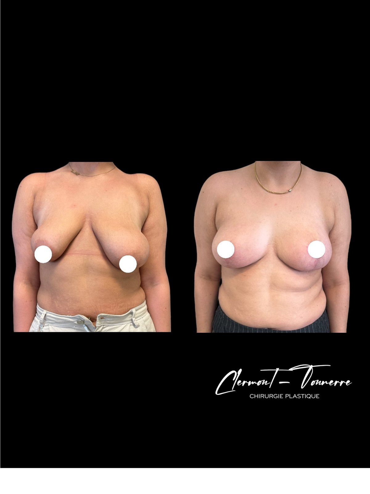 Résultat correction seins tubéreux — Dr. de Clermont-Tonnerre Pontoise
