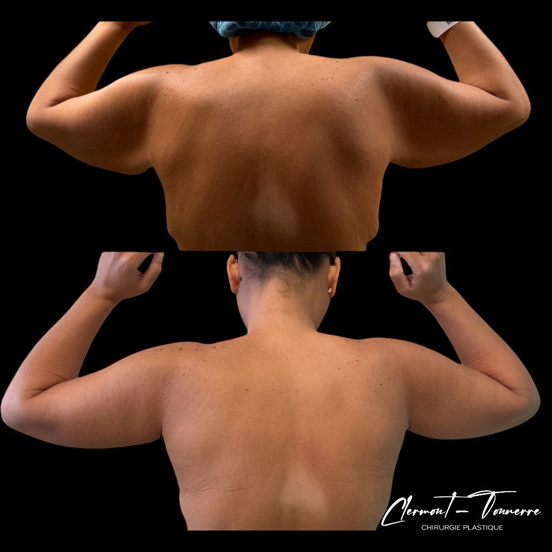 Brachioplastie résultat — cicatrice face interne