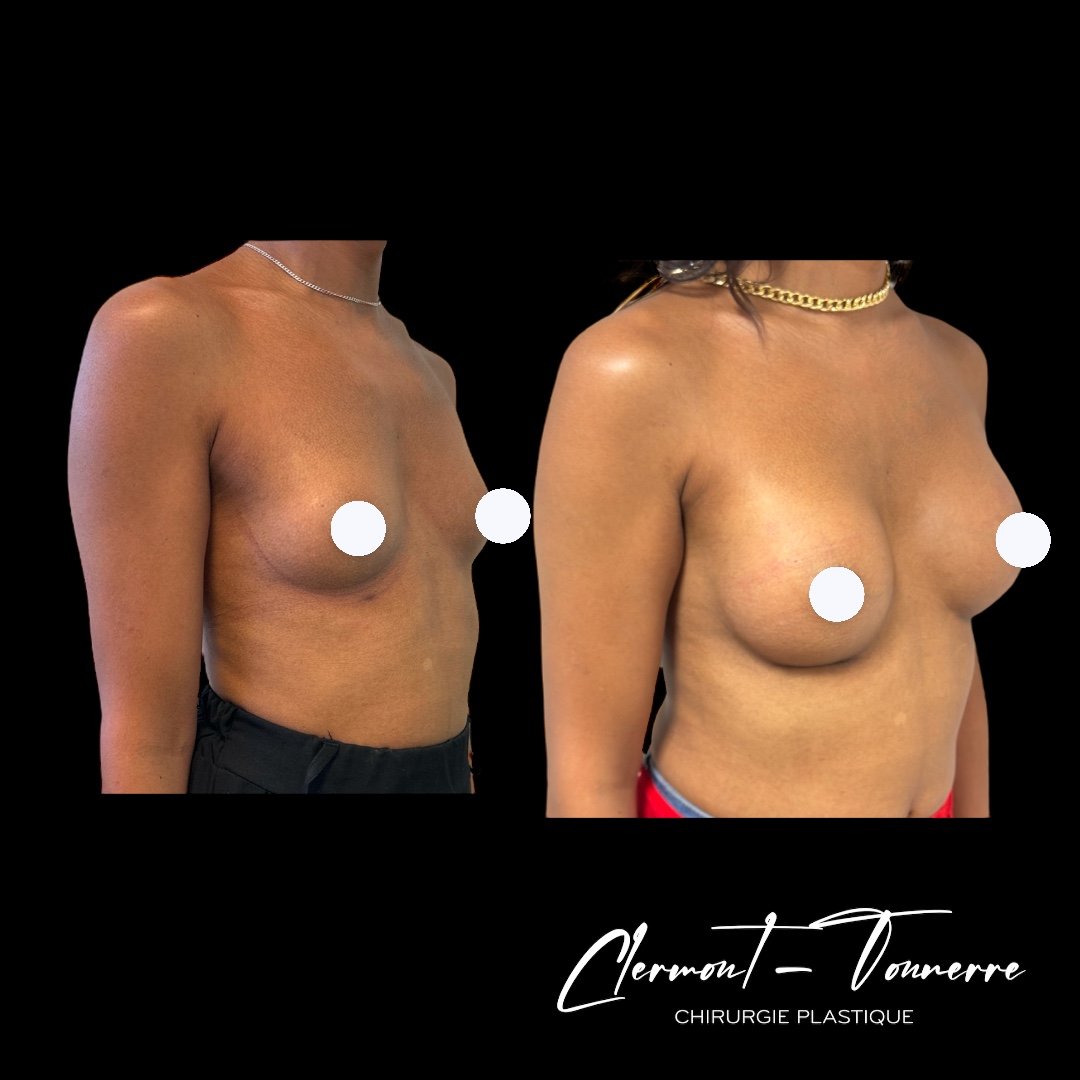 Avant/après féminisation des seins — chirurgie trans MtF Paris