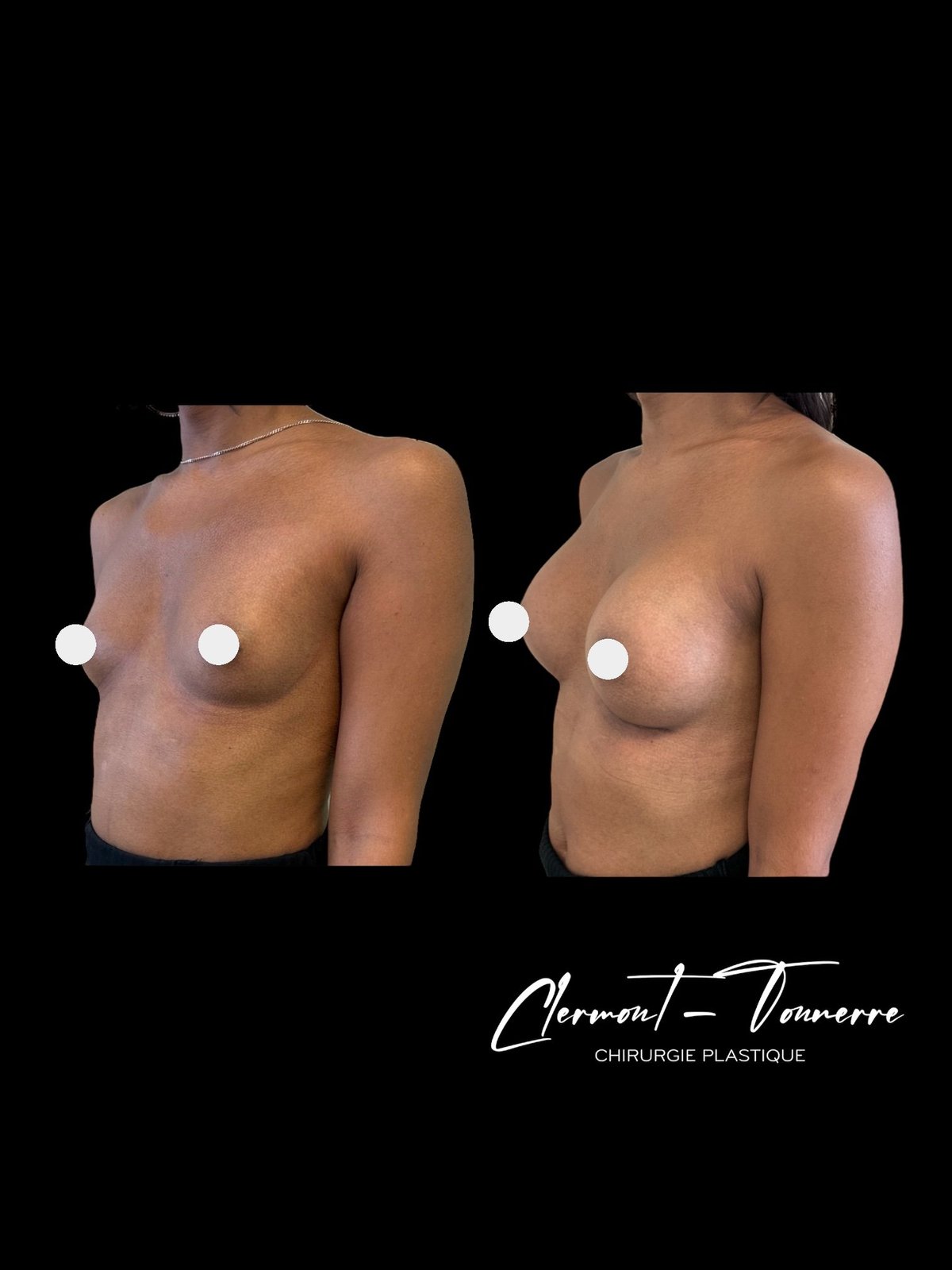 Résultat féminisation thoracique — Dr. de Clermont-Tonnerre