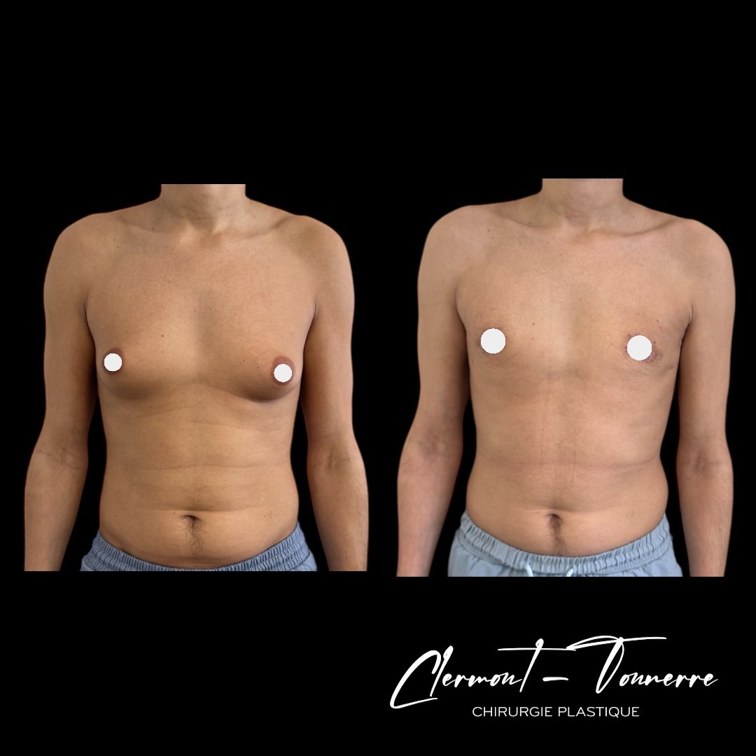 Résultat gynécomastie — correction poitrine masculine Dr. de Clermont-Tonnerre