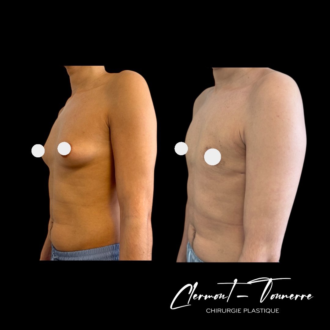 Avant/après gynécomastie — chirurgie plastique Paris & Pontoise