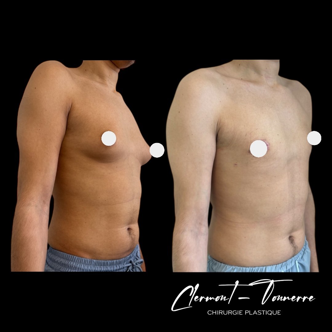 Résultat correction gynécomastie — torse masculin rafermi